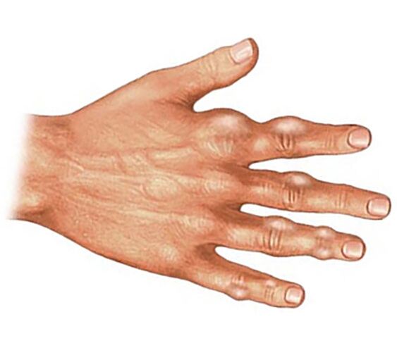 Εναπόθεση κρυστάλλων ουρικού οξέος στους μαλακούς ιστούς των δακτύλων με ουρική αρθρίτιδα