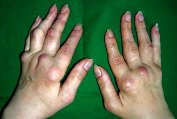 Χέρια προσβεβλημένα από παραμορφωτική πολυοστεοαρθρίτιδα